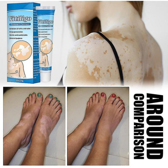 20g Treatment Moisturizing Cream White Spot Disease Vitiligo Balm Repair Ointment