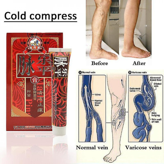Varicose Vein Cream For Spider Veins Varicose Veins Removal Leg Care Safety Gel Improves Blood