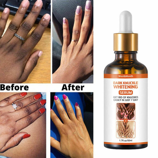 50g West&Month Acanthosis Nigricans Therapy Oil Permanent Whitening