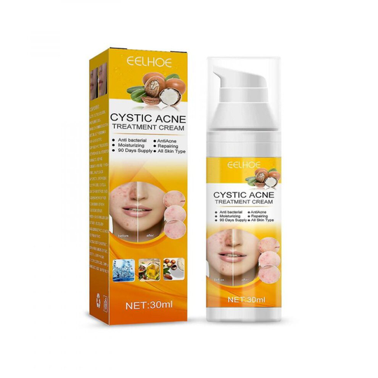 Acne Treat Cream Cystic, Hormonal And Severe Acne Treat Cream For Adolescent And Adult Acne Treat With Special Anti-acne Ingredients